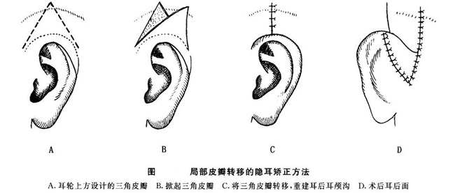 泉州隐耳矫正多少钱